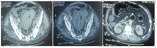 CT images showing a deformed bladder with the presence of a hematoma and air bubbles and from the contents to the dome lateralized to the left. Pneumoperitoneum with peritoneal effusion.