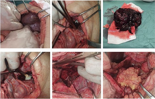 Set of images showing the different operations from the demonstration of the hematoma through the peritoneum to the placement of the omentum after cystorraphy.