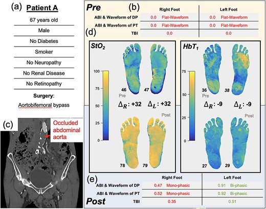 Illustration of Patient A’s clinical summary, pre-operative and post-operative values of ABI, arterial Doppler waveform and SFDI parameters.