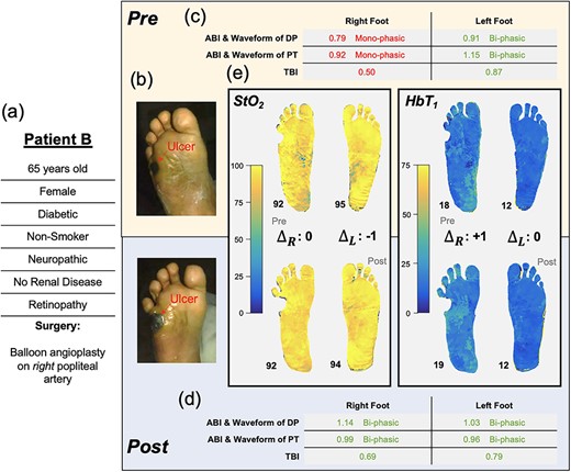 Illustration of Patient B’s clinical summary, pre-operative and post-operative values of ABI, arterial Doppler waveform and SFDI parameters.