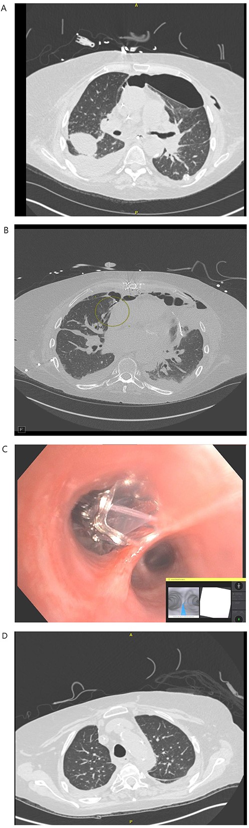 (A) POD 21 BL pneumothorax and R pleural effusion. (B) POD 31 BPF with medial segment RML with BL pneumothorax and R hydropneumothorax. (C) POD 35 placement of endobronchial valve in medial segment of RML. (D): POD 41 resolution of BPF, pleural effusion and pneumothorax.