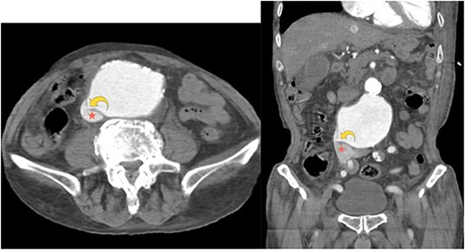Axial computed tomography angiography image showing a small focal defect in the aortic wall (curved yellow arrow). Abnormal early opacification of the IVC (red star) can be noticed in this arterial phase study. These findings are consistent with an aortocaval fistula. No retroperitoneal hematoma is observed.