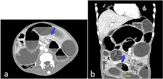 (a) CT abdomen and pelvis showing possible swirling of mesentery (blue arrow); (b) CT abdomen and pelvis showing dilated and collapsed small bowel loops suggestive of transition zone (blue arrow).