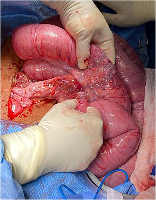 Intraoperative findings of dilated small bowel with transition zones from tumor.