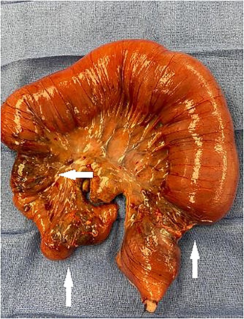 Segment of small bowel encompassing three tumors (white arrows) resected en bloc.