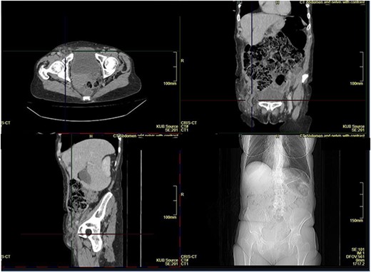 CT scan showing femoral hernia.