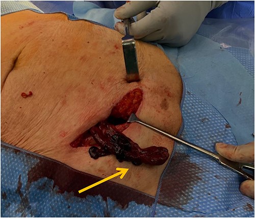 Intraoperative photo showing the femoral hernia containing a gangrenous appendix.