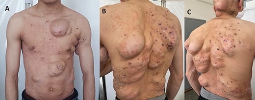 Subcutaneous abscesses with a ringworm of the trunk; (A) ventral view; (B) and (C) dorsal view.