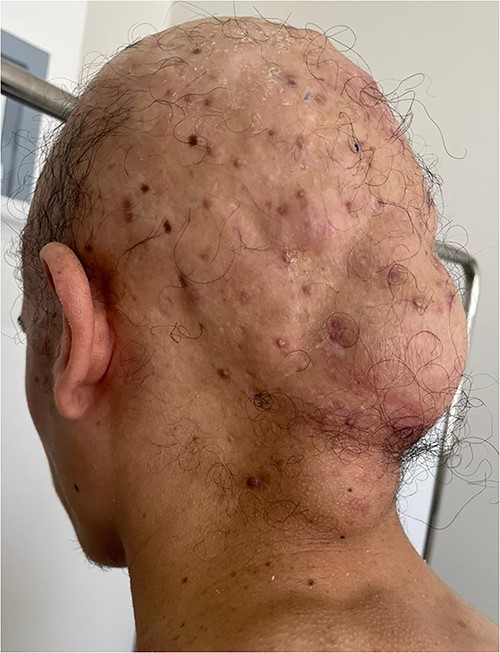 Scarring alopecia with subcutaneous formations.