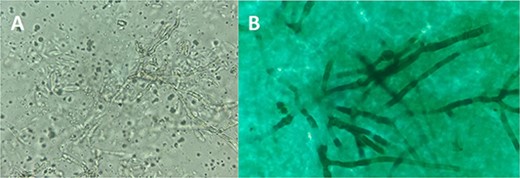 Microscopic examination of pus sample from intact nodules; (A) Fresh microscopic examination at 40× magnification showing abundant septate mycelium hyphae with multiple microconidia; (B) Gomori-Grocott’s methenamine silver staining showed black fungi on a pale green background, confirming the diagnosis of deep dermatophytosis.