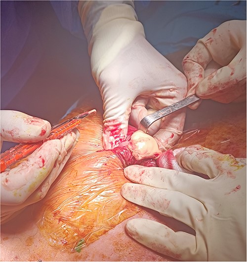 Abscess incision and evacuation of its content.