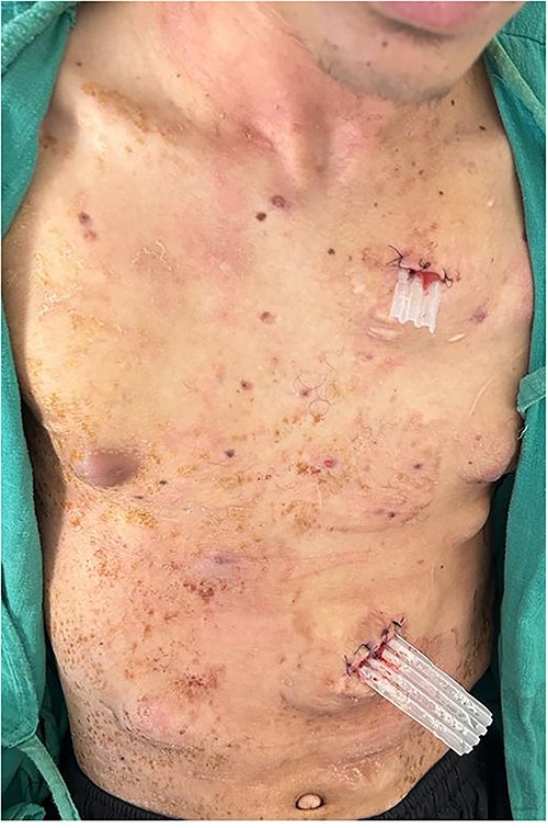 Postoperative image with Delbet blades in place.