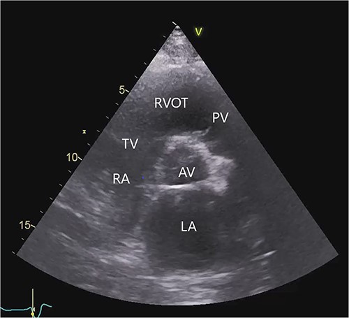 Transthoracic echocardiogram before LVAD implantation. Parasternal short-axis view. AV (aortic valve), LA (left atrium), PV (pulmonary valve), RA (right atrium), RVOT (right ventricular outflow tract), TV (tricuspid valve).