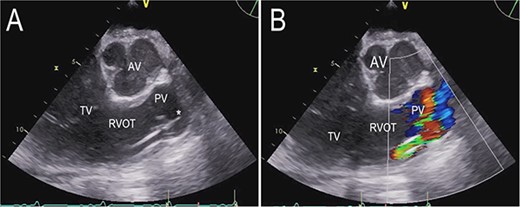 Transthoracic echocardiogram after implantation of a percutaneous RVAD with two cannulas via the right IJV and right FV. Parasternal long-axis view demonstrating the cannula position in the pulmonary valve (A). Color Doppler transthoracic echocardiogram after implantation of a percutaneous RVAD with two cannulas via the right IJV and right FV. Parasternal long-axis view demonstrating severe pulmonary regurgitation due to cannula position in the pulmonary valve (B). AV (aortic valve), PV (pulmonary valve), RVOT (right ventricular outflow tract), TV (tricuspid valve), * tip of cannula.
