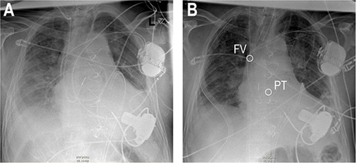 Anteroposterior thoracic radiography after LVAD implantation (A). Anteroposterior thoracic radiography after RVAD cannulation of the PT (B). Tip of cannula in the right FV, tip of cannula in the PT.
