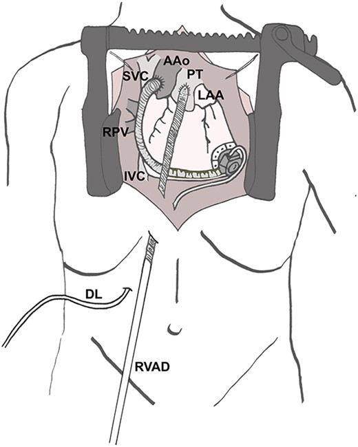 Surgical site after implantation of the cannula in the PT. AAo (ascending aorta), DL (driveline of left ventricular assist device), IVC (inferior caval vein), LAA (left atrial appendage), PT (pulmonary trunk), RPV (right pulmonary veins), RVAD (cannula of right ventricular assist device) SVC (superior caval vein).