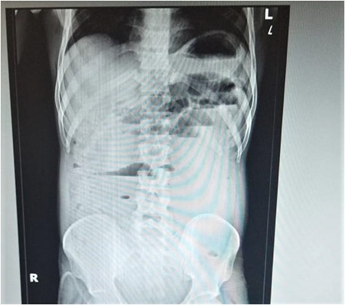 The erect abdominal X-ray reveals air-fluid levels, indicating the presence of fluid and air accumulation in the proximal large bowel and terminal ileum.