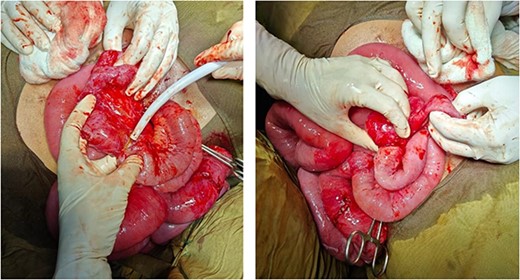 Adhesions from constriction ring at the level of terminal ileum causing intestinal obstruction.