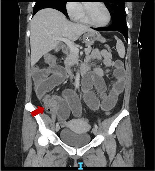 Coronal slice CT abdomen pelvis showing SBO with transition point at the distal ileum secondary to a possible mass.