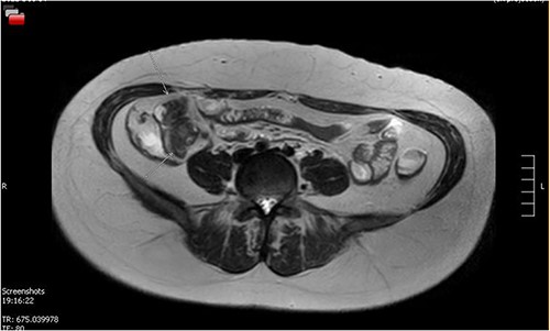 MRE showing small bowel lesion ~10 cm proximal to the ileocaecal valve.