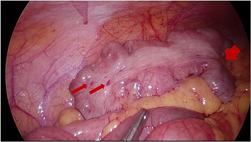 Intraoperative image at laparoscopy showing TI tethered down into cicatrizing mass. Foci of endometriosis on proximal large bowel.