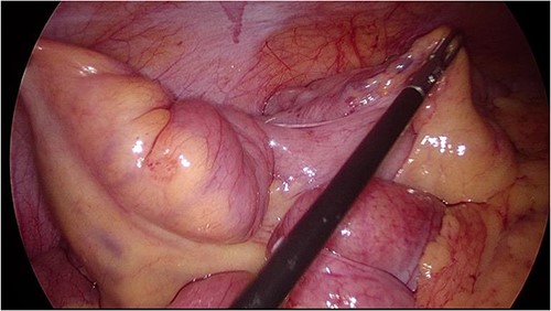 Intraoperative image at laparoscopy showing dilated distal small bowel loop and tethered TI (unable to straighten out bowel).