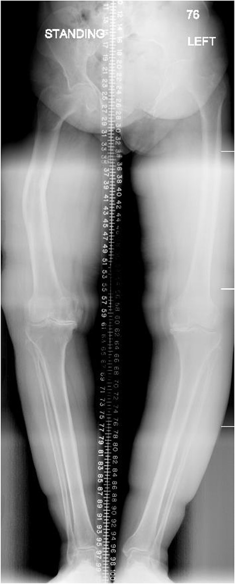 Preoperative anteroposterior standing bilateral lower extremity radiographs displaying long leg alignment and the right femur Varus deformity.