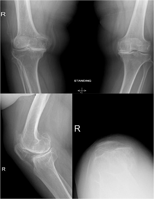 Preoperative anteroposterior, lateral and sunrise radiograph views displaying tri-compartmental osteoarthritis.
