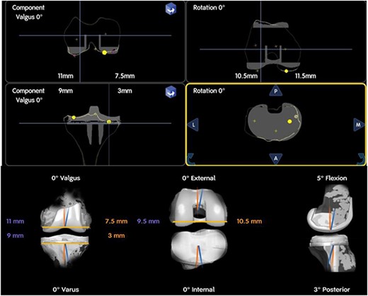 Intra-operative planning of components’ position showing distal femoral cuts: 11 mm medially and 7.5 mm laterally, proximal medial tibial cut is 9 mm and 3 mm laterally.