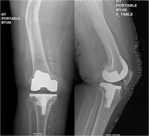 Postoperative anteroposterior and lateral radiograph views of the status of post RATKA.