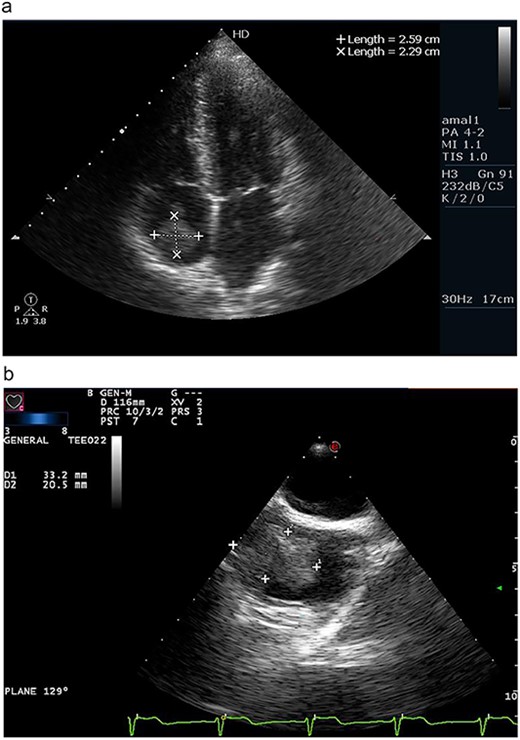 (a) Apical four chamber view on transthoracic echocardiography revealing a right atrial mass measuring 2.59 × 2.29 cm. (b) Transesophageal echocardiography confirming the presence of wide-based, irregular and lobulated right atrial mass measuring 3.32 × 2.05 cm.