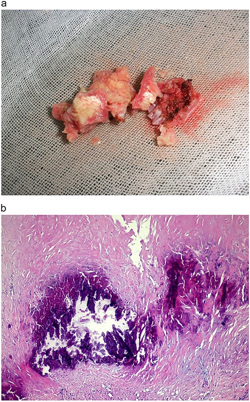 (a) Gross view of the resected tumor appearing irregular, soft and measuring 3 × 2.5 × 2 cm. (b). Microscopic image of the tumor specimen demonstrating wide eosinophilic degenerated fibrin background, with many irregular and nodular calcified deposits; small foci of myxoid mixture associated with bland spindle cells and scattered collections of foamy histocytes.