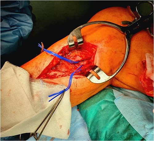 Venous patching after a popliteal endarterectomy.