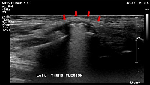 Sonogram of the left wrist showing a ruptured FPL tendon. The arrow points to the discontinuity in the tendon, indicating the site of rupture.