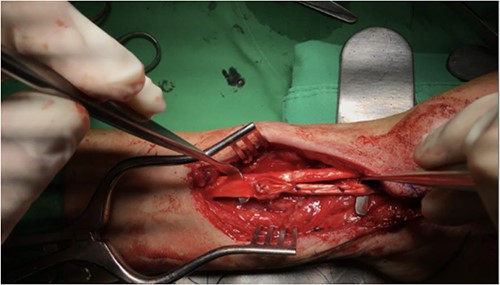 The patient underwent plate removal, tenolysis and tendon graft reconstruction on 19 January 2021.