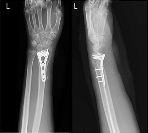 Left wrist X-ray showing a fracture over the radius with compression plate fixation.