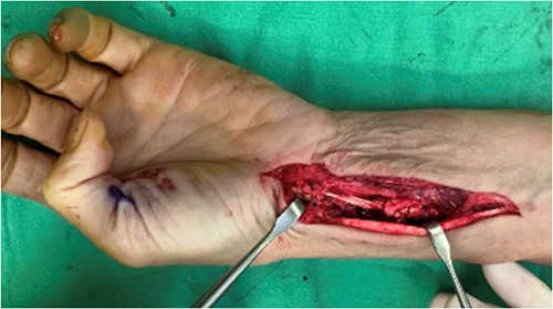 Post-operative photo showing removal of volar plate, tenolysis, release of flexor retinaculum and tendon graft reconstruction of FPL that were performed on 1 November 2022.