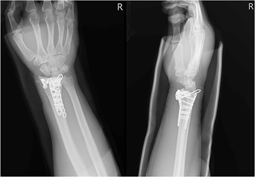 Right wrist X-ray showing a fracture located at the distal radius and carpal bones, which was surgically treated with internal fixation.