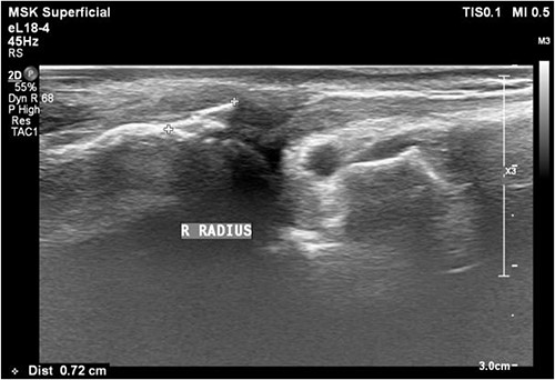 Sonogram of the right thumb showing an injured flexor tendon. Asymmetric fibrillar structures of the right FPL tendon were observed.