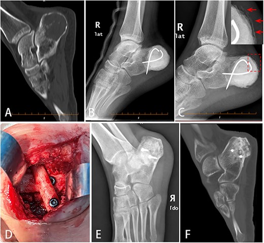 Bone defect reconstruction using Masquelet technique for calcaneal chondroblastoma. (A) X-ray showed osteolytic bone lesion located in posterior of right calcaneus body. The cortex was thinned because of tumor aggression. (B) After tumor was removed totally, bone cement (PMMA) was filled into the cavity and fixed with two cross Kirschner wires. (C) Six weeks later, the induced membrane on the calcaneal surface could be seen obviously (indicated by arrow). (D) Autologous fibular segment shoring and bone graft were filled into the cavity to reconstruct the defect. (E,F) Eleven months later, DR (E) and CT (F) scan showed good bone healing.