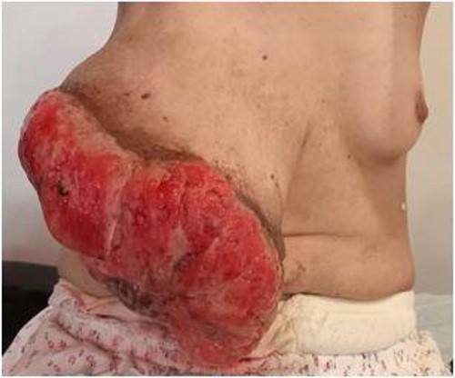 Clinical examination: mass ulcero-budding, occupying the whole right breast, with total destruction of the nipple-areolar plate.