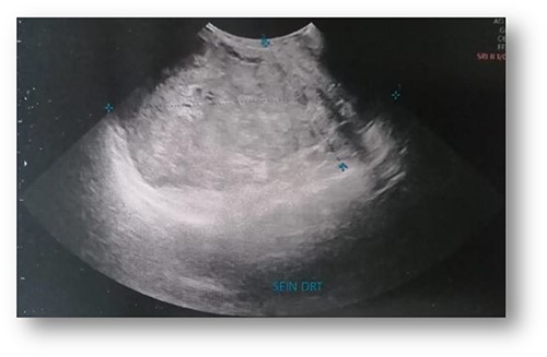 Ultrasonographic examination: large heterogenous hypoechoic mass with polylobed contours of 18 × 16 × 10 cm.