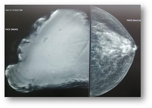 Mammography: voluminous opacity with a focus of vermicular microcalcifications.