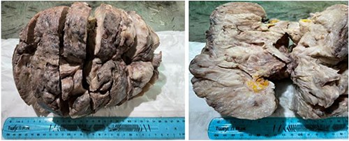 Macroscopic examination: mass, firm, focally fleshy appearance, myxoid and necrotic areas.