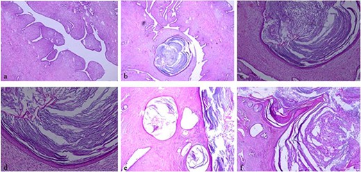 Histologic examination, hematoxylin and eosin stain: (a, ×5) showing typical leaf-like pattern with moderate cellularity of the stromal component. (b, ×5), (e, ×5) and (f, ×5) showing typical leaf-like pattern with moderate cellularity of the stromal component and cystic squamous metaplasia. (c, ×10) and (d, ×20) showing cystic squamous metaplasia.