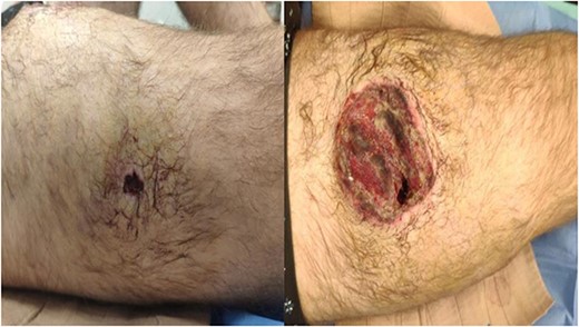 Entry (left) and exit (right) wounds as found at Role 2.