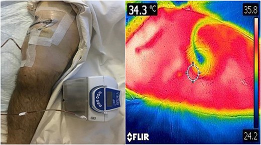 : NPWT in situ with corresponding DDT image.