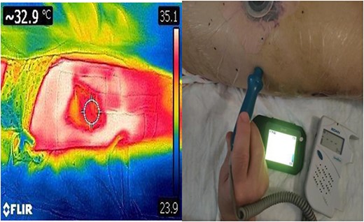 DDT identification of the perforating vessels of the lateral thigh with corresponding confirmation using audio Doppler.