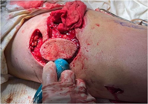 Intraoperative confirmation of the perforating vessel.