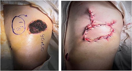 Pre-op marking (left) and immediate post-op appearance (right).